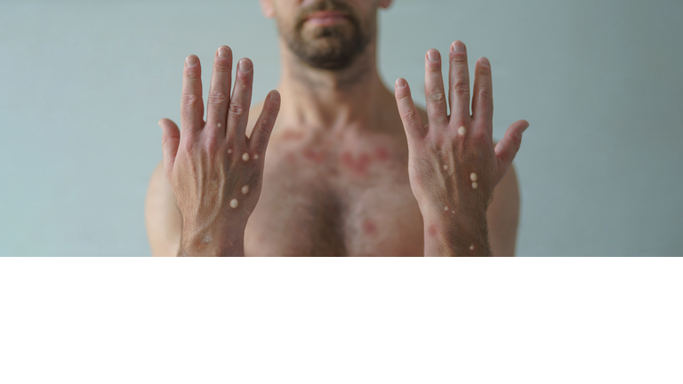 Male hands affected by blistering rash because of monkeypox or other viral infection on white background