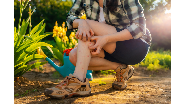 Allergies and insect bites concept. Person scratches her legs, which is itchy from a mosquito bite. Close up. Summer garden on the background