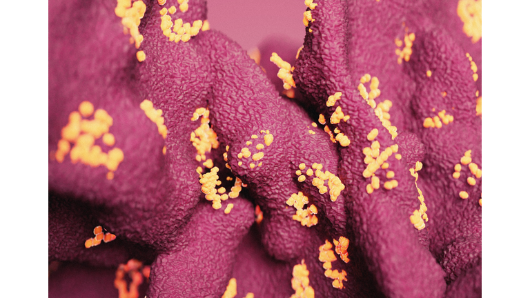 New Langya heni pavirus infection in human tissue