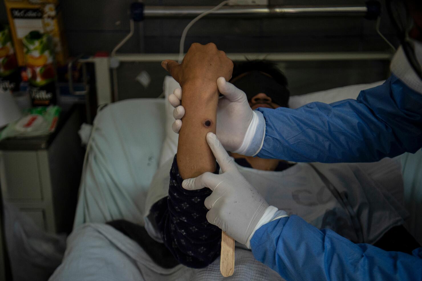 PERU-HEALTH-VIRUS-MONKEYPOX