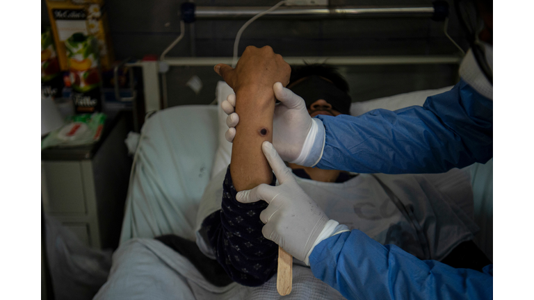 PERU-HEALTH-VIRUS-MONKEYPOX