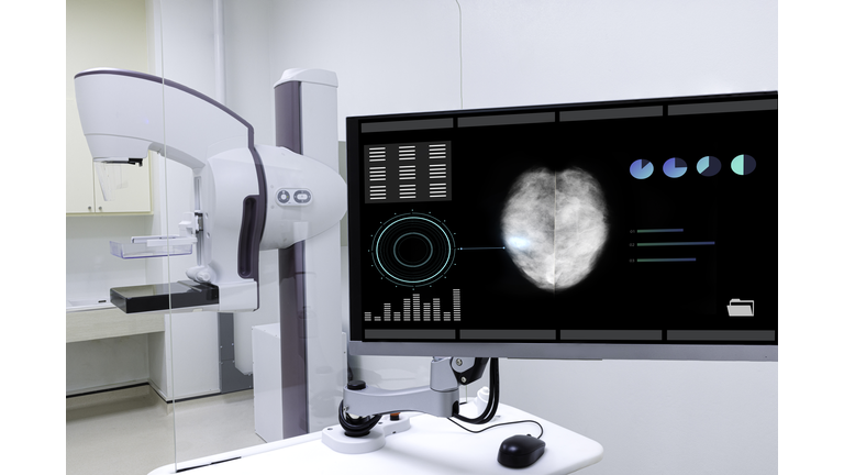 A mammogram machine showing breast cancer image on a computer monitor.