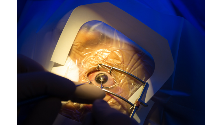 SINGAPORE-HEALTH-EYE-LASIK