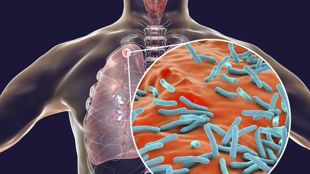 U.S. Tuberculosis Cases Surged To Highest Level In Ten Years
