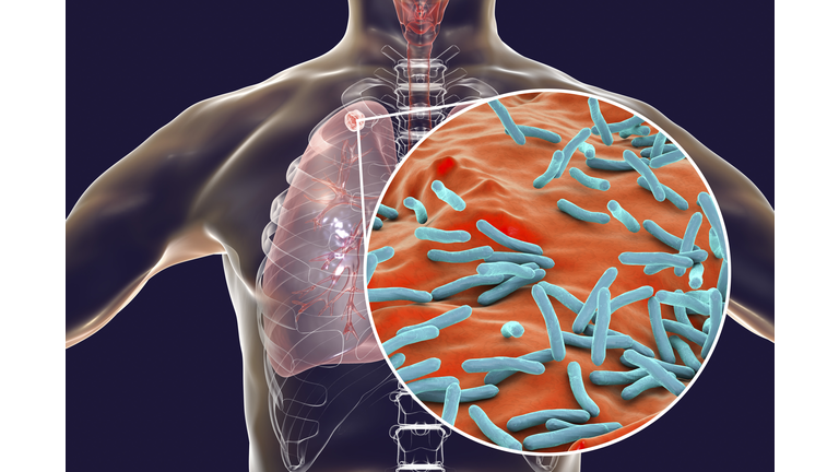 Secondary tuberculosis infection, illustration