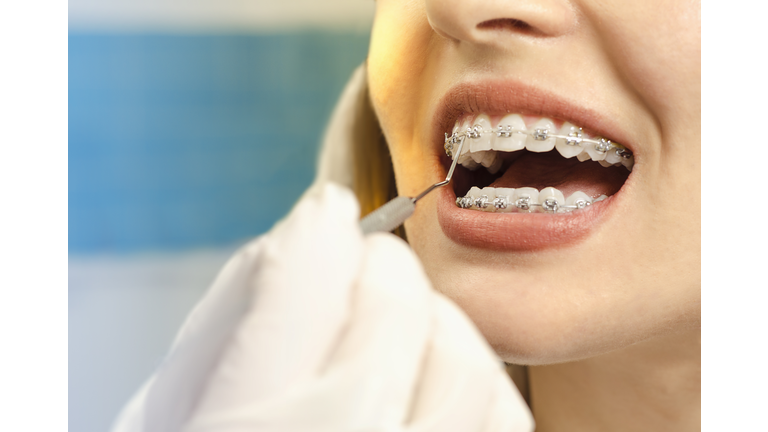 Closeup dental braces checkup