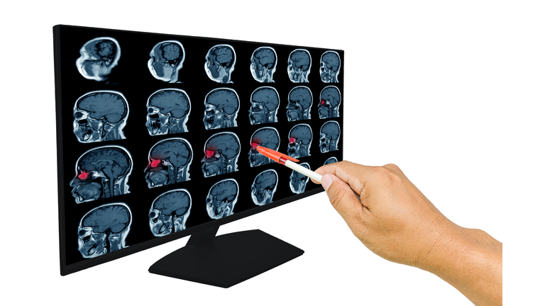 The doctor reported the Magnetic resonance imaging (MRI) of the tumor, sagittal view.A 56 years old man , with and without contrast media, .Healthcare and education concept.