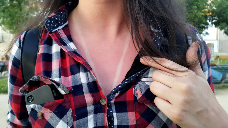 Midsection Of Woman Showing Sunburned On Neck