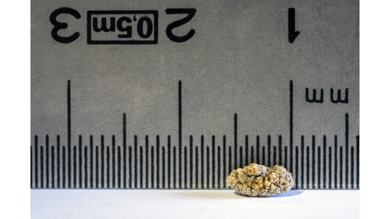 Close-up detail of a kidney stone due to nephritic colic, with a ruler from behind to measure its size.