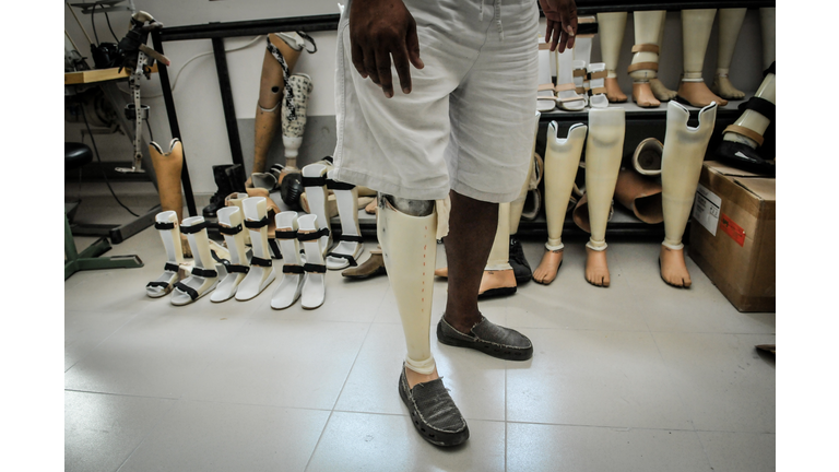 Bali Clinic Produces Prostheses For Local Community