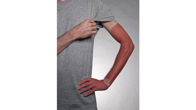 Sunburn on arm