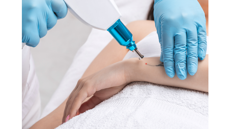 The doctor makes the procedure for laser tattoo removal on the girl's arm.