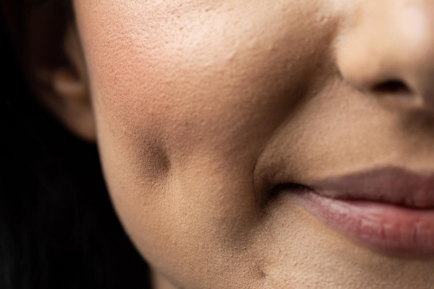 Cheek dimple