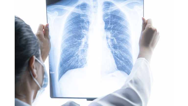 Female doctor analyzing lung x ray film in the lab