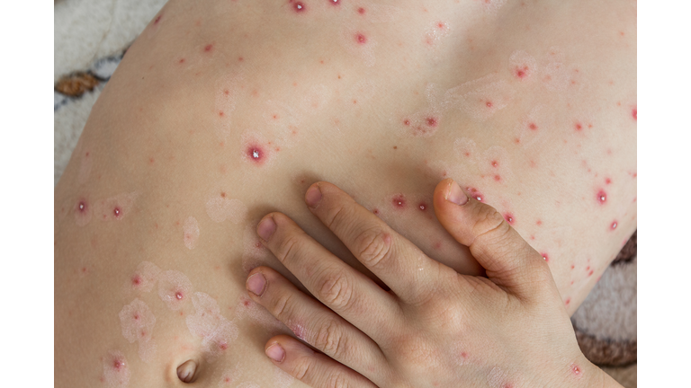 Part of child's body with chickenpox bubbles