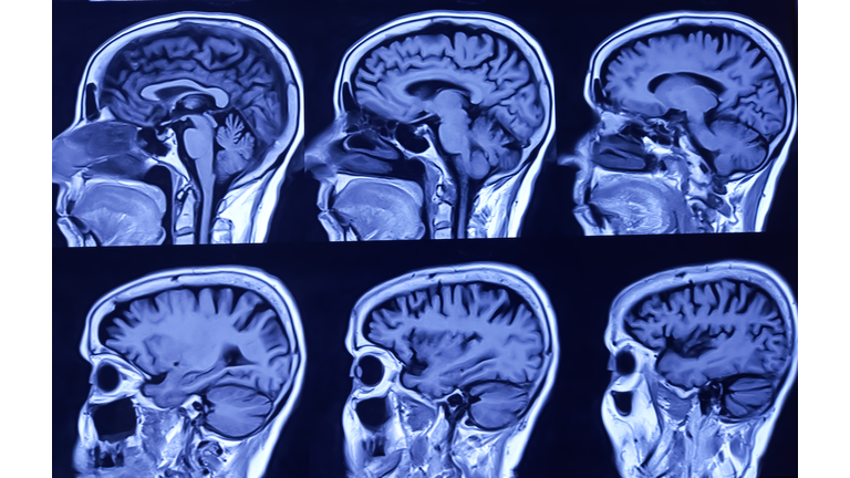 MRI (Magnetic Resonance Image) of brain. Cerebral cortical atrophy.