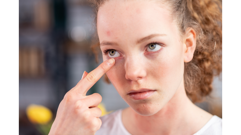 Unfortunate young lady with curly hair itching her eyelid