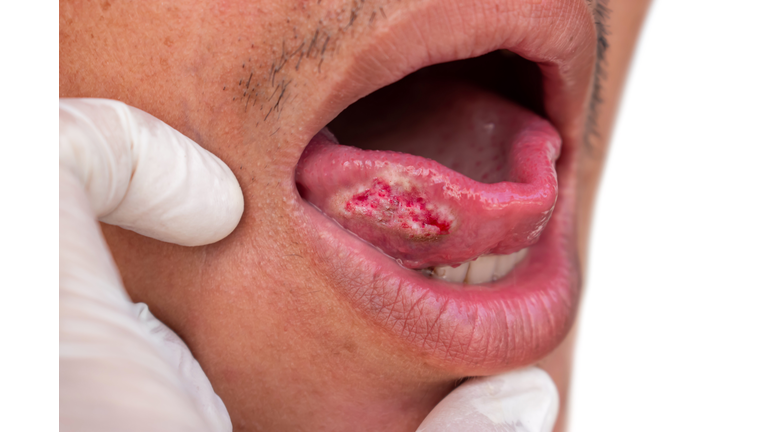 Squamous cell carcinoma of tongue. Oral cancer or malignant tumor.