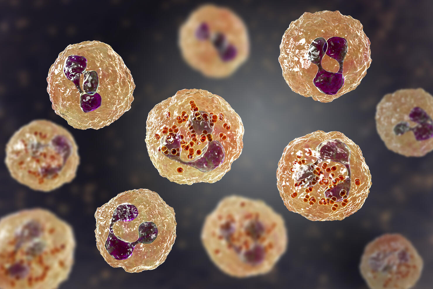 Meningococcal meningitis, illustration