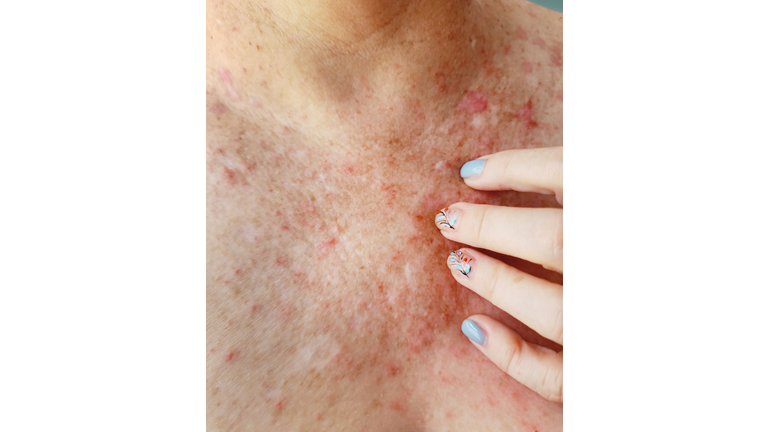 Woman's Hand Scratching Her Chest and Neck with an Affectation on Her Skin