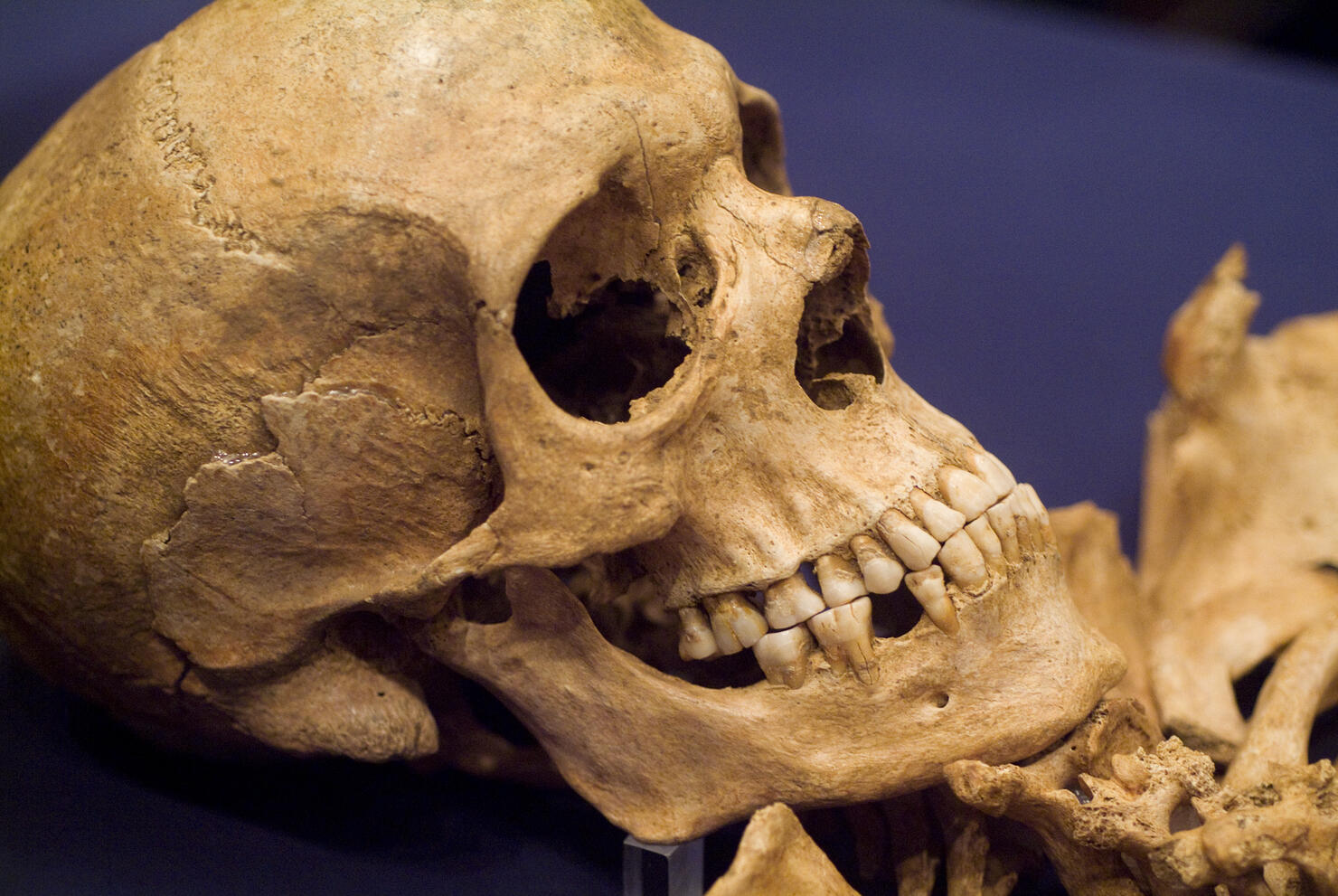 Skull of Early Settler