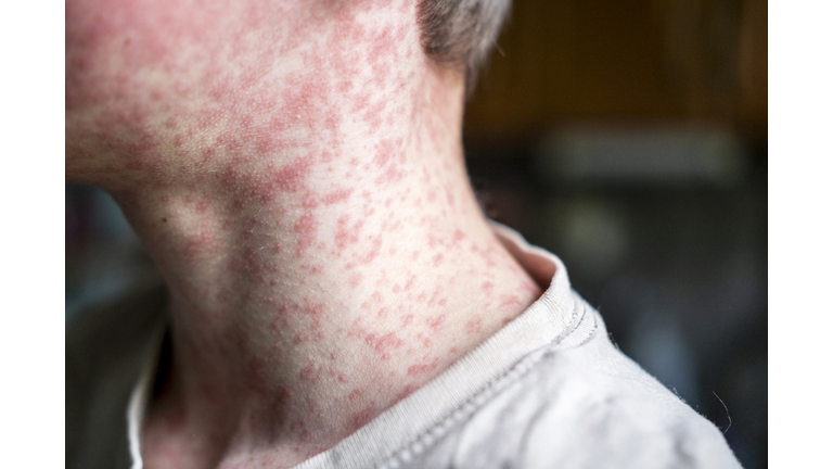Measles viral disease, human skin covered with measles rash, vaccination concept