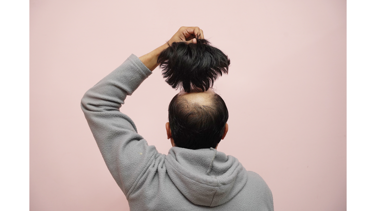 Closeup of a half-bald male removing his wig while wearing a hoodie with a pink background