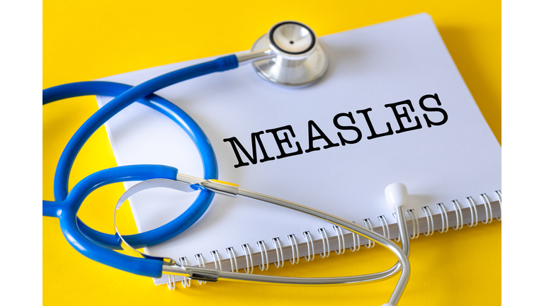 Measles, an acute viral respiratory disease that affects children