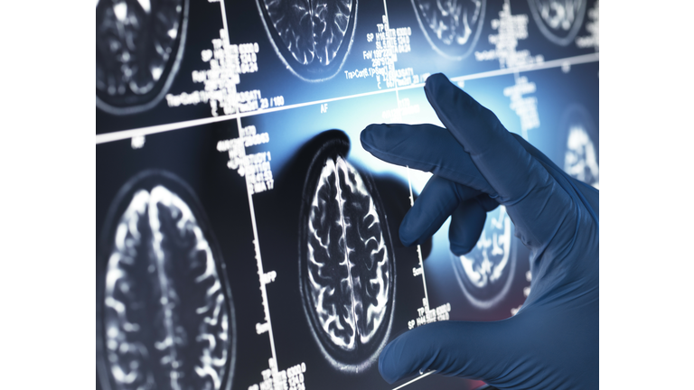 Neurology Research, Doctor examining a human brain scan on screen