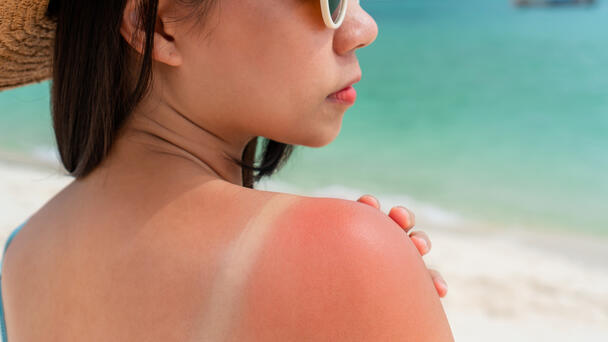 The "Skincase" Will Let You Know When Your Skin Is Burning In The Sun