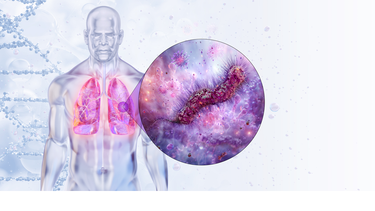 Lung infection caused by Legionella pneumophila bacteria