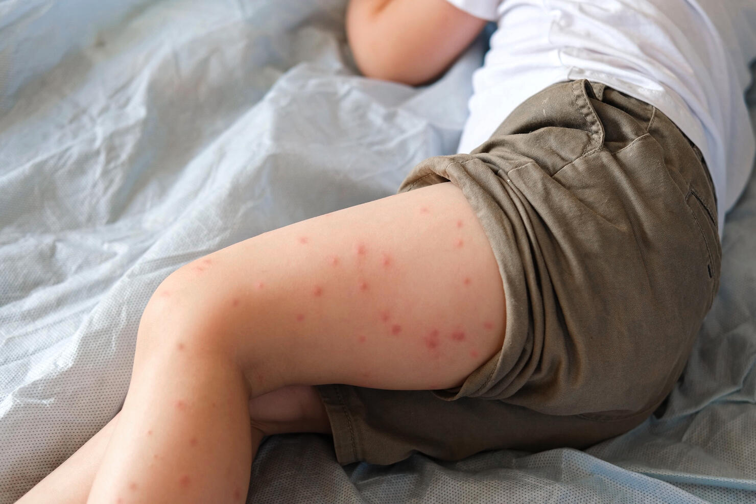 Child scratch body has sensitive itchy skin. Bodily rash. Kid allergy closeup. Little baby scratches eruption. Irritation, hive. Pruritus. Mosquito insect bite. Red from sunburn, Seborrheic Dermatitis