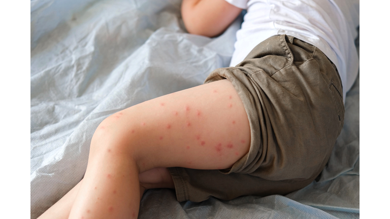 Child scratch body has sensitive itchy skin. Bodily rash. Kid allergy closeup. Little baby scratches eruption. Irritation, hive. Pruritus. Mosquito insect bite. Red from sunburn, Seborrheic Dermatitis
