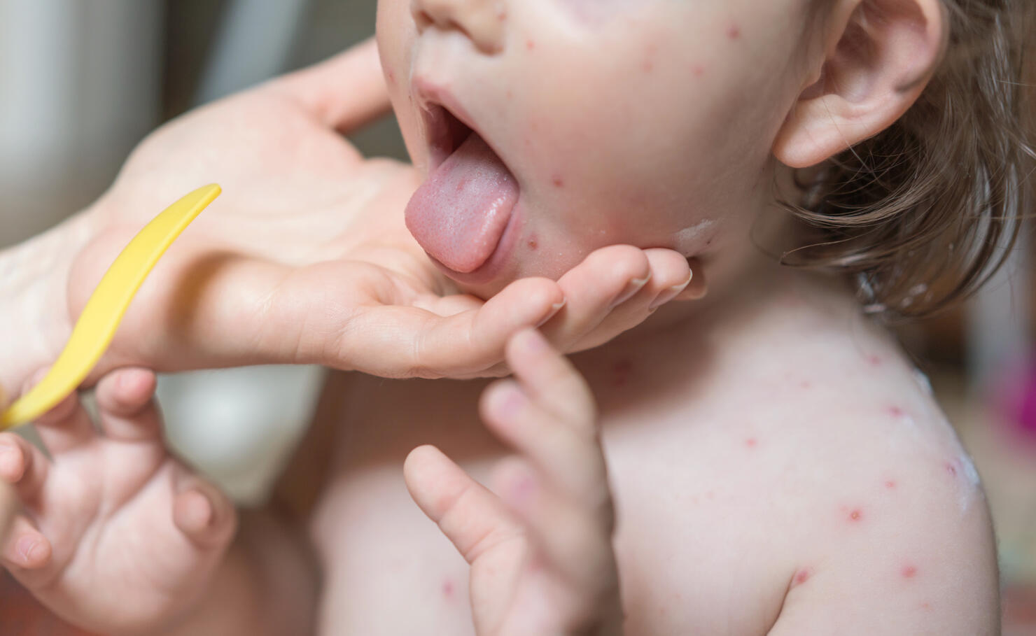 Little girl with chickenpox at the doctors