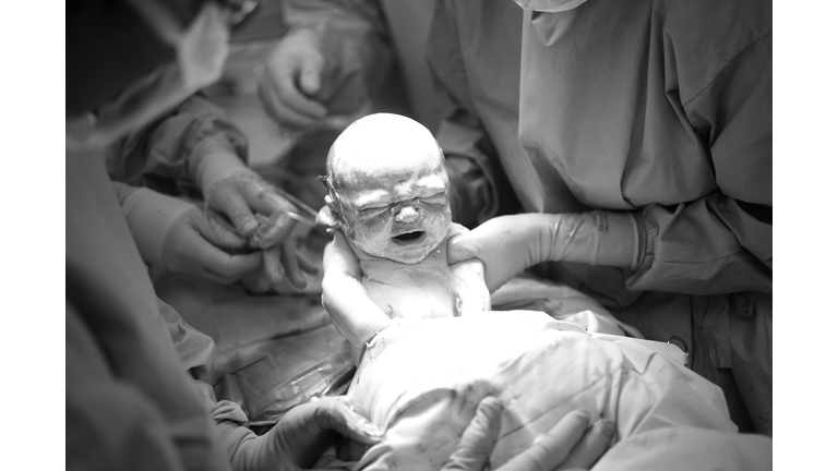 A baby being born by Caesarean Section