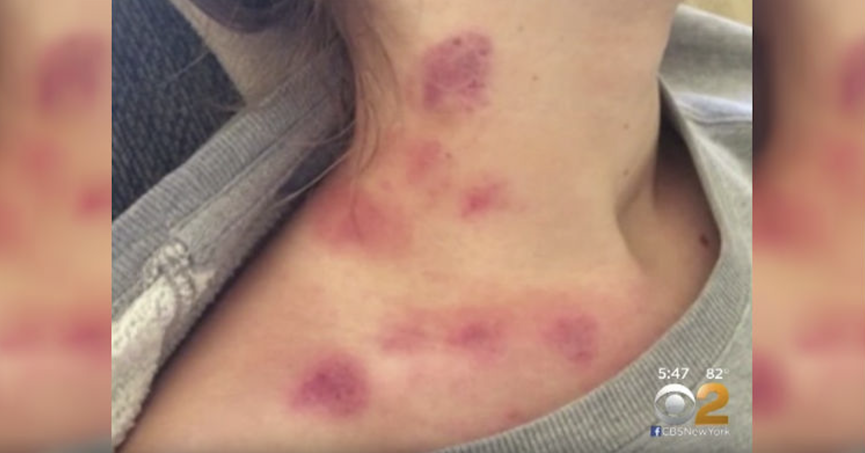 Can hickies cause blood deals clots