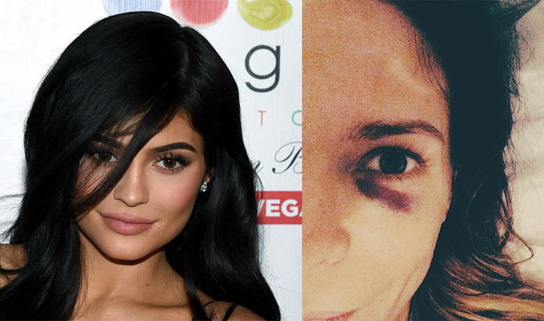 Kylie Jenner's Black Eye Has People Asking Questions | iHeart