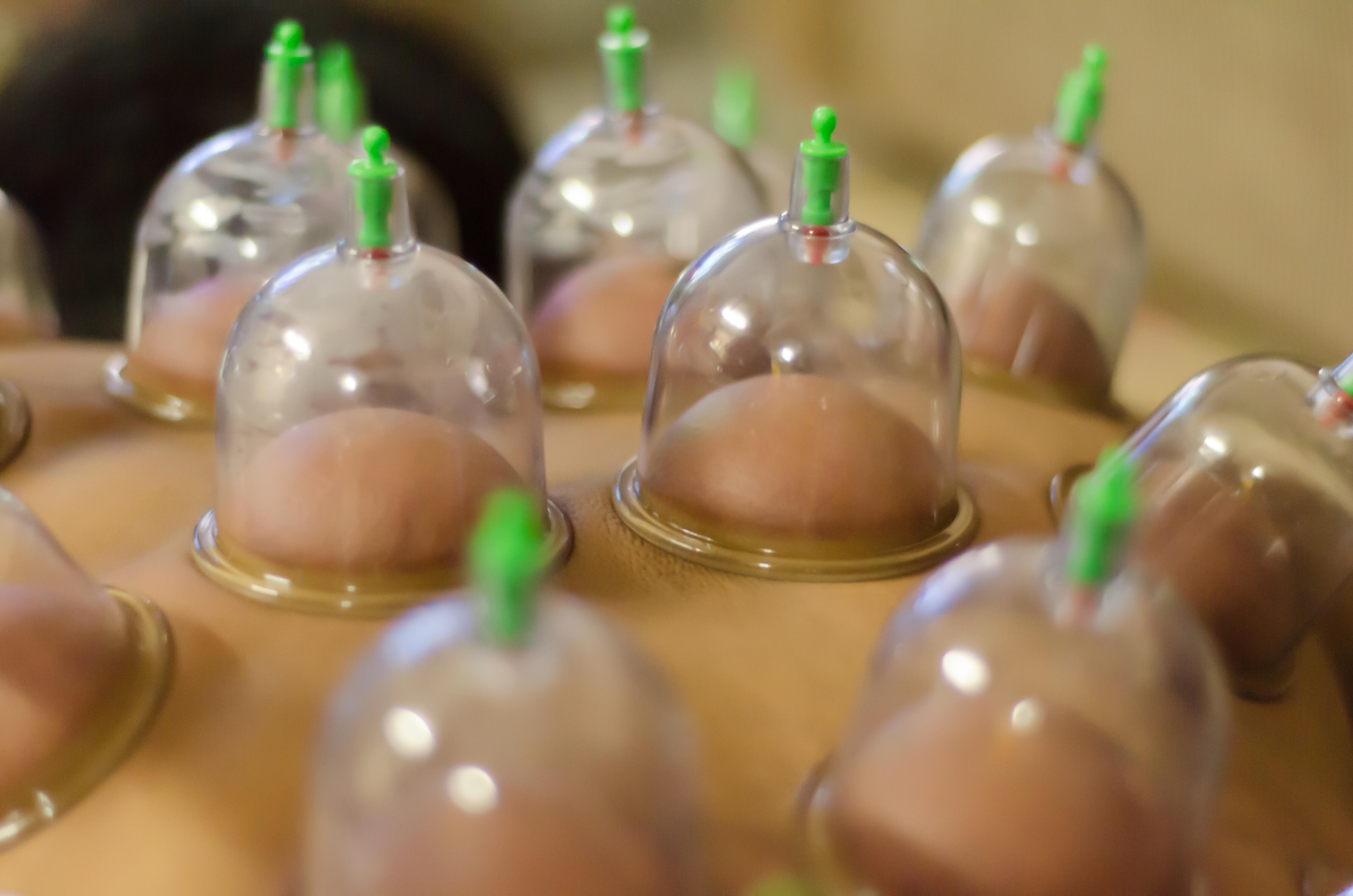 Woman Has Nightmare Experience After Cupping Session - Thumbnail Image