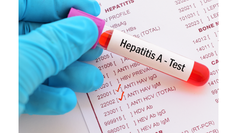 Hepatitis A Getty RF