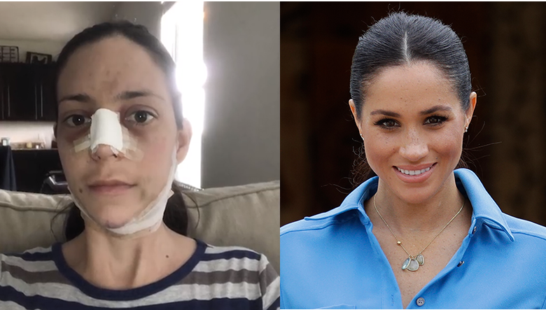 Mom Of Three Spends $25K On Surgery To Look Like Meghan Markle - Thumbnail Image