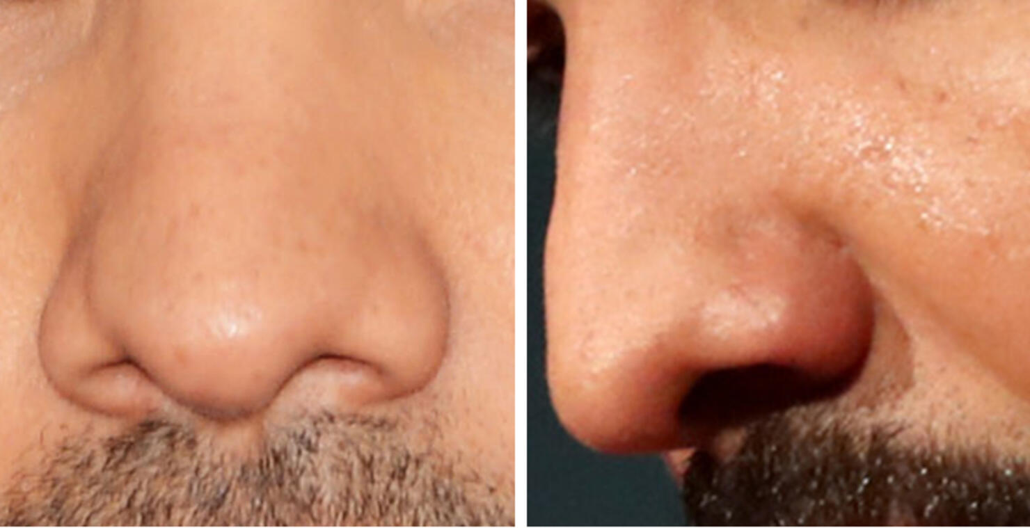 Guess The Celeb Nose!