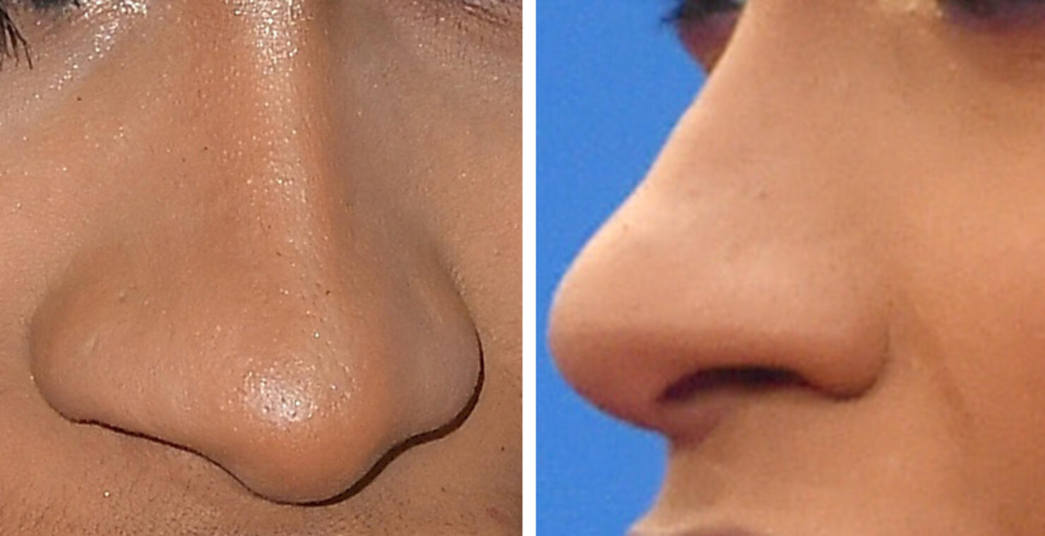 Guess The Celeb Nose!