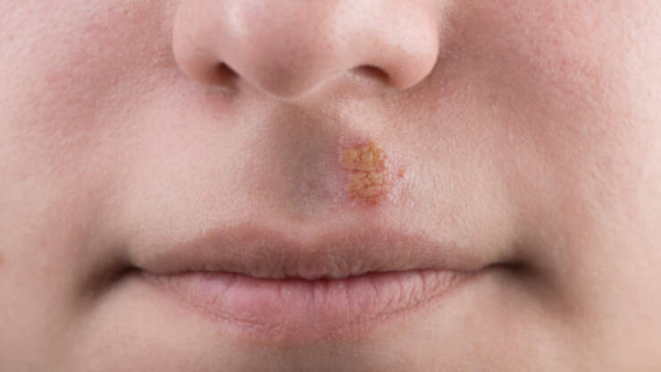 Nose blisters, anyone? | DC101 | Elliot In The Morning