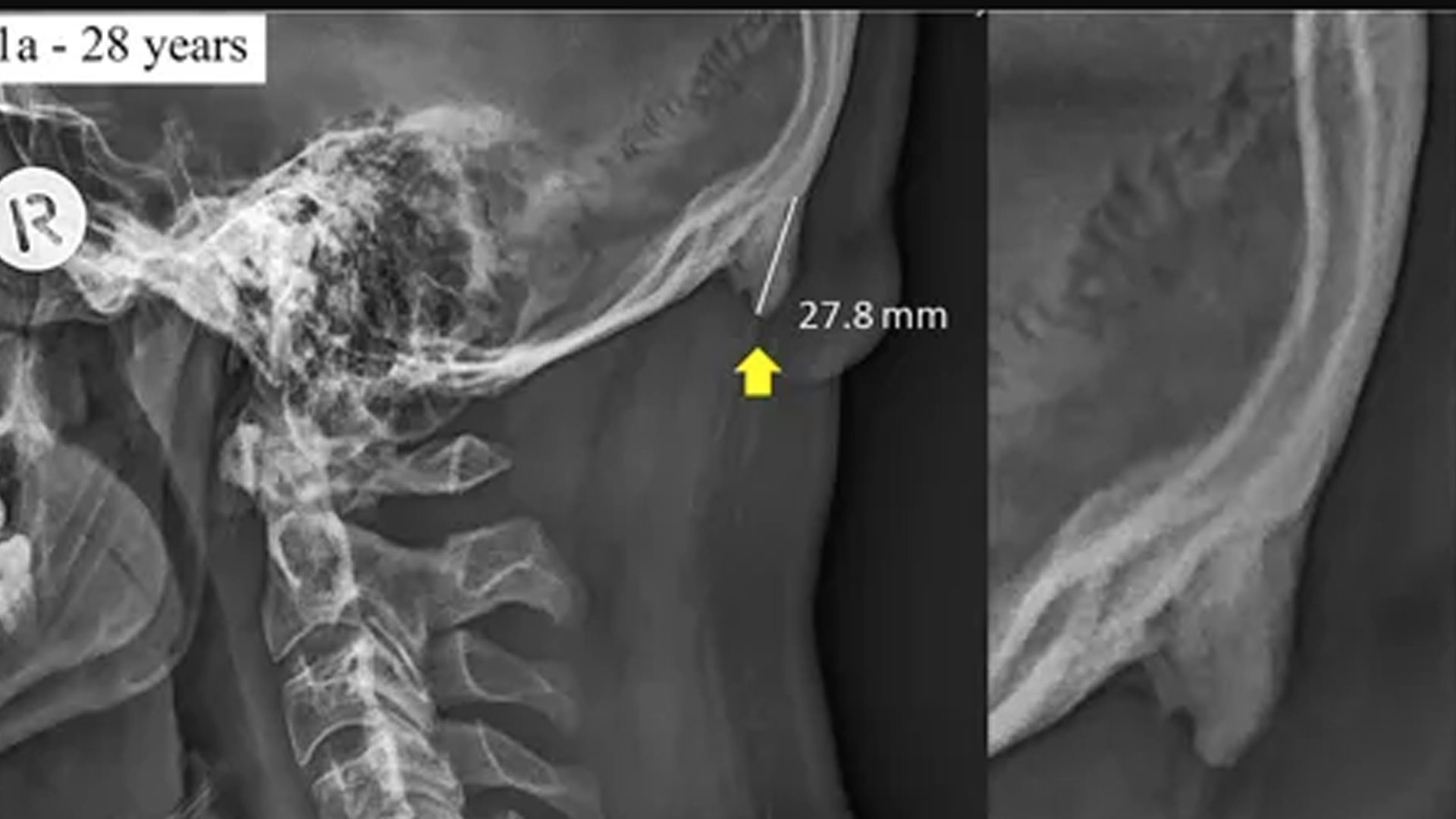 Smartphones Responsible For Strange Skull Bone Growths, Researchers Say - Thumbnail Image