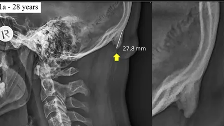 smartphone use blamed for rash of bone spurs growing on people's skulls. 