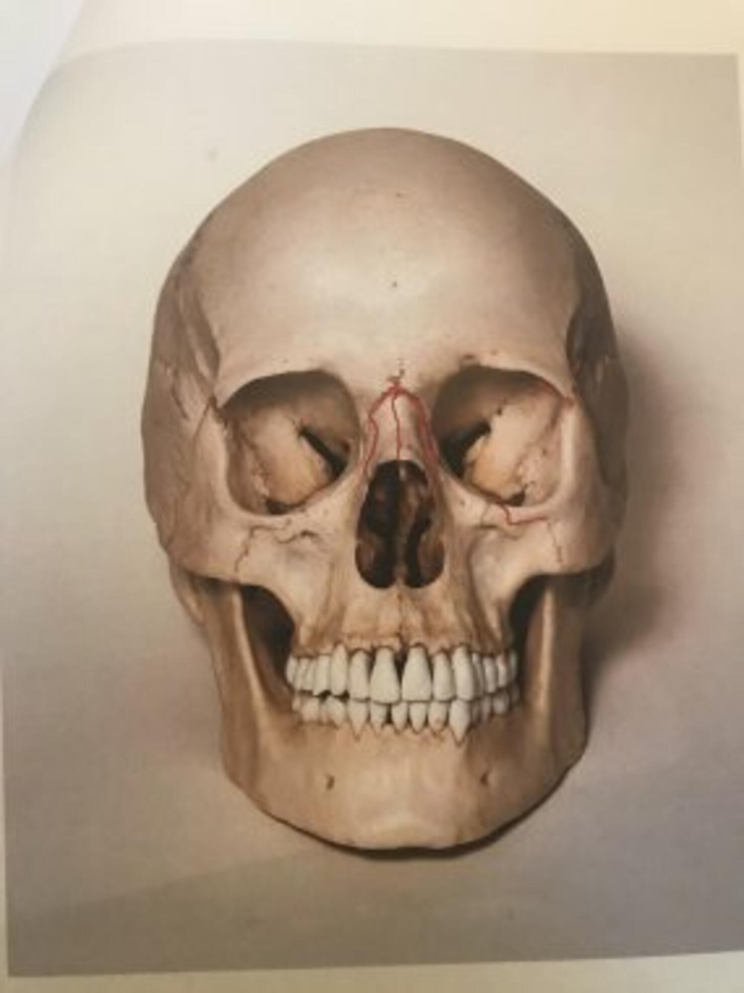 Recreation of injuries to Rebekah's skull showing the location of fractures.