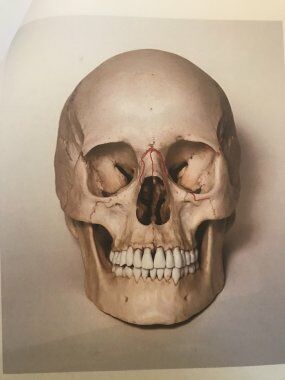 Recreation of injuries to Rebekah's skull showing the location of fractures.