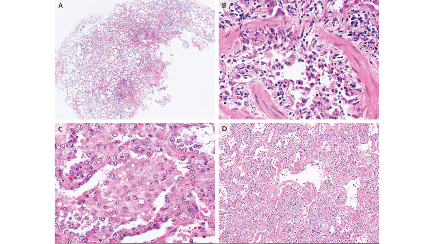 Lung illness resembles toxic chemical burns
