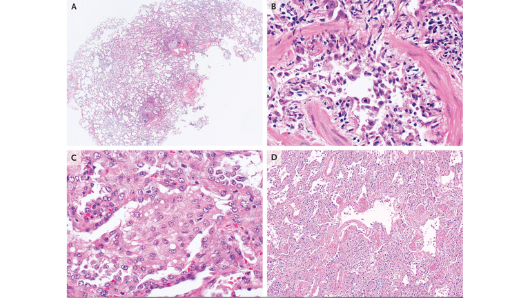 Lung illness resembles toxic chemical burns