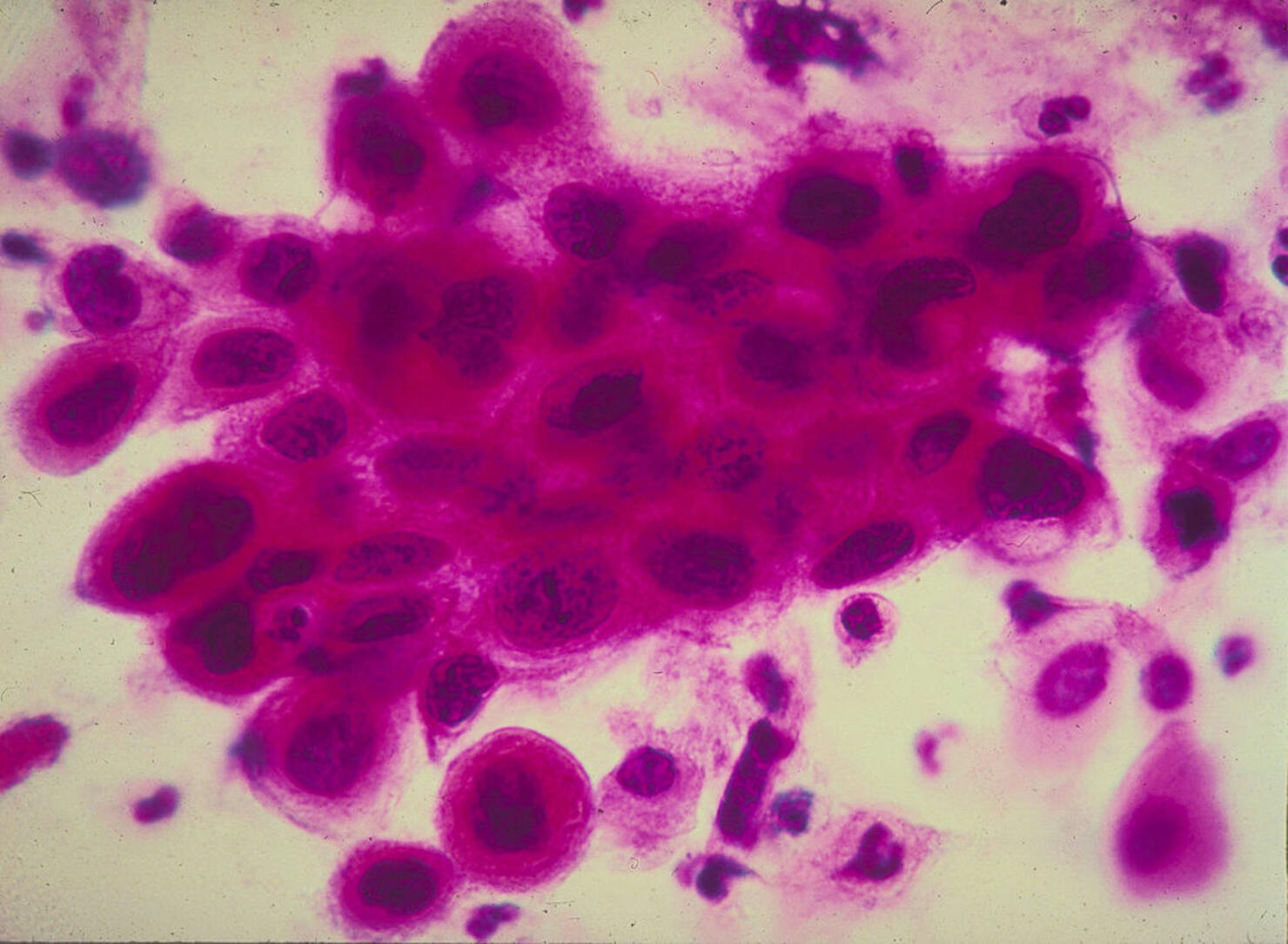 Cancer Images